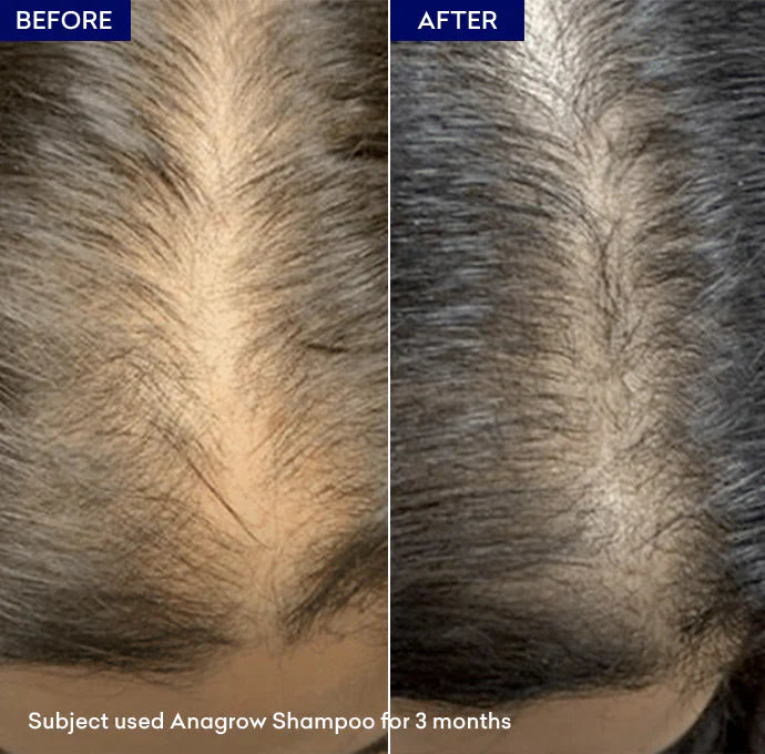 Anagrow Shampoo - The Skin Lab