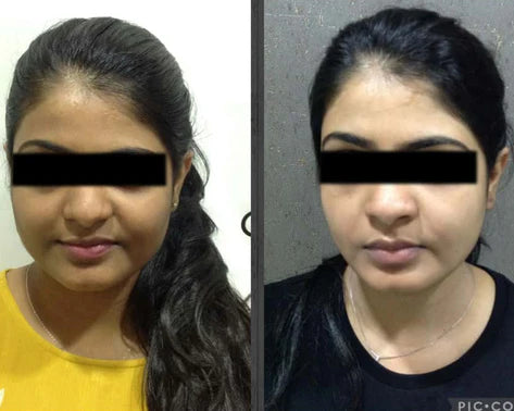 Neutro Skin Whitening Before After Injection